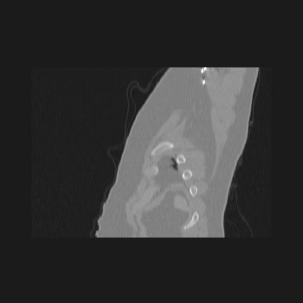Bronchial atresia (Radiopaedia 60685-68439 Sagittal lung window 96).jpg