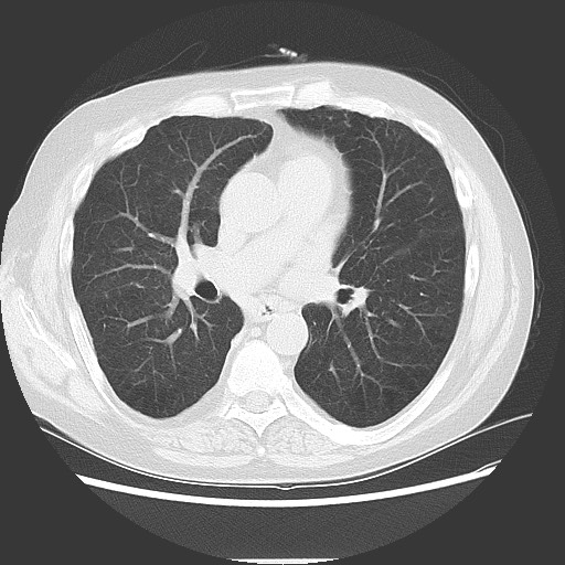 Bronchial stenosis - lung transplant (Radiopaedia 73133-83848 Axial lung window 33).jpg