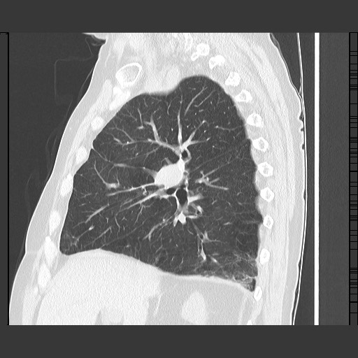 Bronchial stenosis - lung transplant (Radiopaedia 73133-83848 Sagittal lung window 27).jpg