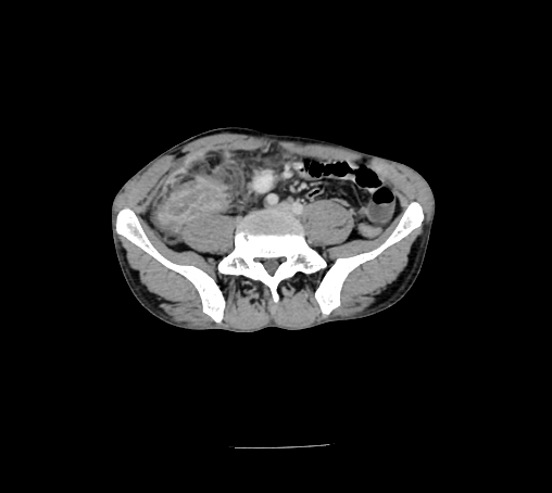 File:Bronchiectasis in Crohn disease (Radiopaedia 60311-67977 B 117).jpg