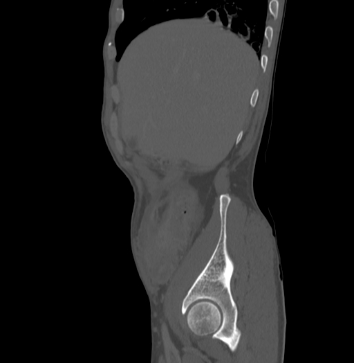 Bronchiectasis in Crohn disease (Radiopaedia 60311-67977 Sagittal bone window 27).jpg
