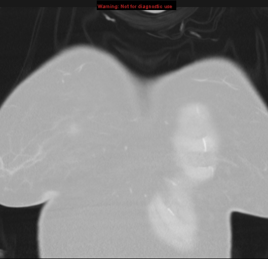Bronchoalveolar carcinoma (BAC) (Radiopaedia 13436-13392 Coronal lung window 3).jpg