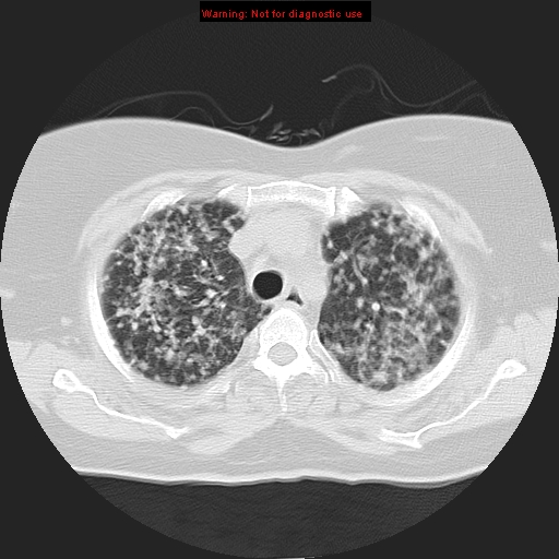 Bronchoalveolar carcinoma (Radiopaedia 13224-13233 Axial lung window 13).jpg