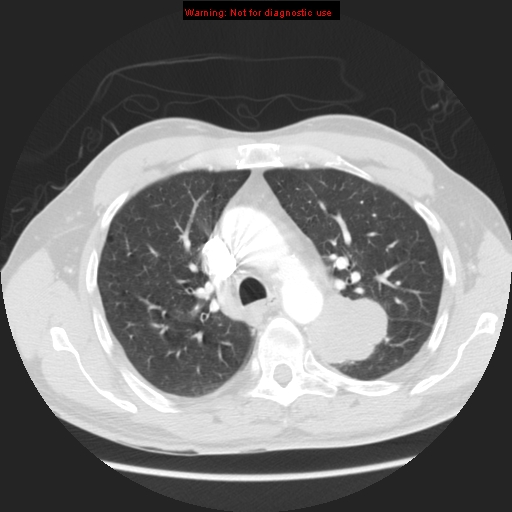 File:Bronchogenic carcinoma brain metastasis (Radiopaedia 9286-105832 Axial lung window 13).jpg