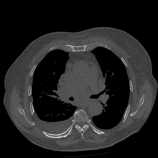 Bronchogenic carcinoma with metastatic lymphadenopathy (Radiopaedia 37671-39569 Axial bone window 26).jpg