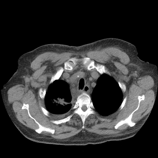 Bronchogenic carcinoma with metastatic lymphadenopathy (Radiopaedia 37671-39569 Axial non-contrast 10).jpg