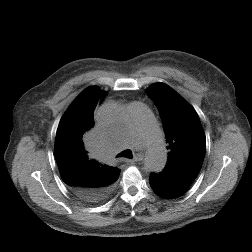 Bronchogenic carcinoma with metastatic lymphadenopathy (Radiopaedia 37671-39569 Axial non-contrast 19).jpg