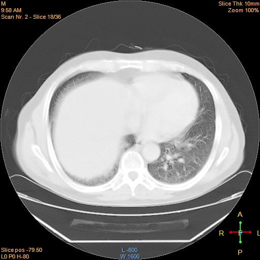 File:Bronchogenic carcinoma with superior vena caval invasion (Radiopaedia 22378-22406 C 15).jpg