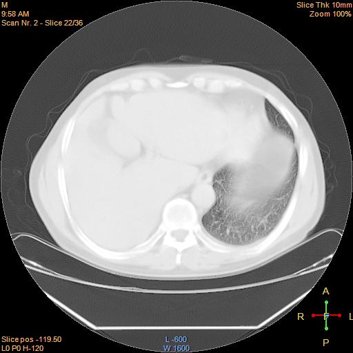 File:Bronchogenic carcinoma with superior vena caval invasion (Radiopaedia 22378-22406 lung window 19).jpg