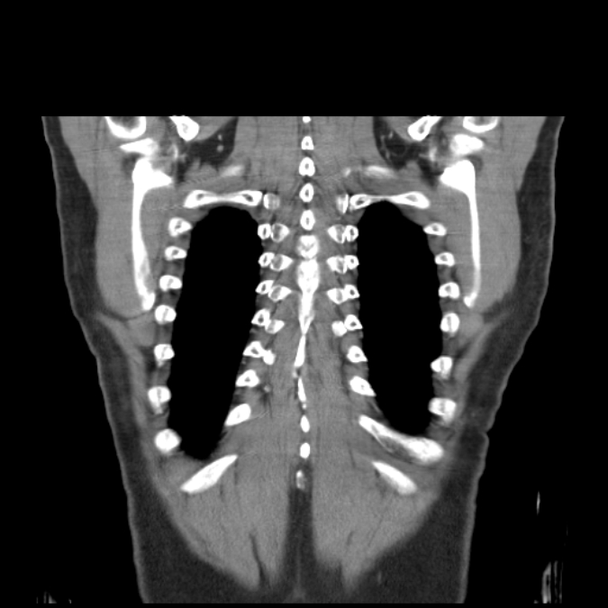 Bronchogenic carcinoma with upper lobe collapse (Radiopaedia 29297-29726 D 49).jpg