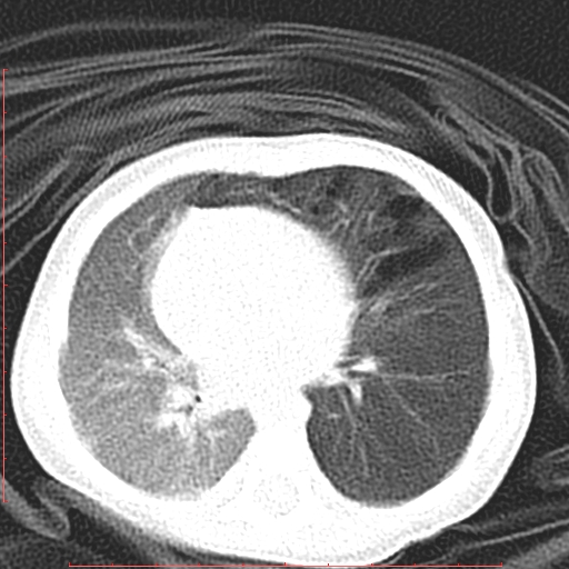 File:Bronchogenic cyst (Radiopaedia 78599-91409 Axial lung window 81).jpg