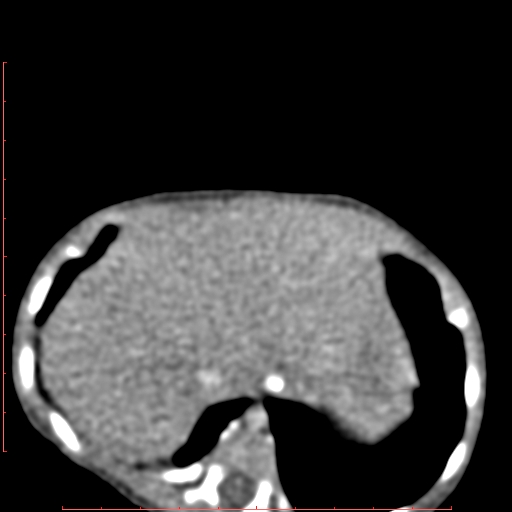 Bronchogenic cyst (Radiopaedia 78599-91409 B 169).jpg