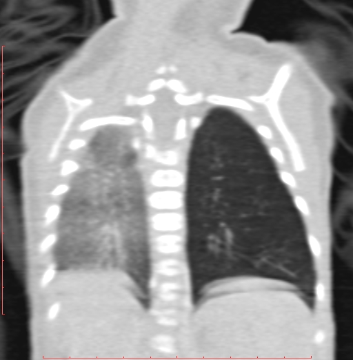 Bronchogenic cyst (Radiopaedia 78599-91409 Coronal lung window 171).jpg