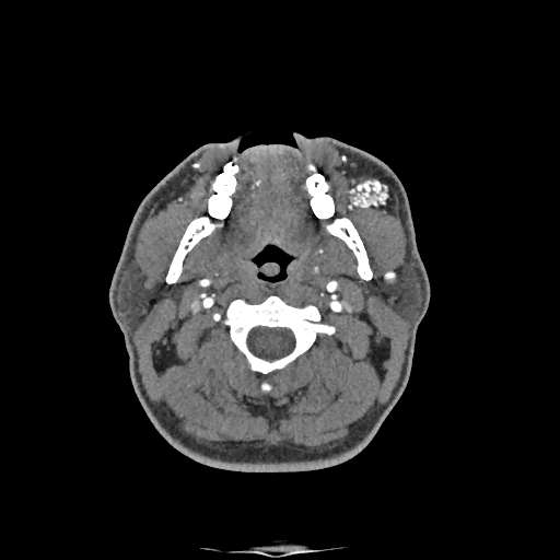 Buccal fat pad arteriovenous malformation (Radiopaedia 70936-81144 D 186).jpg
