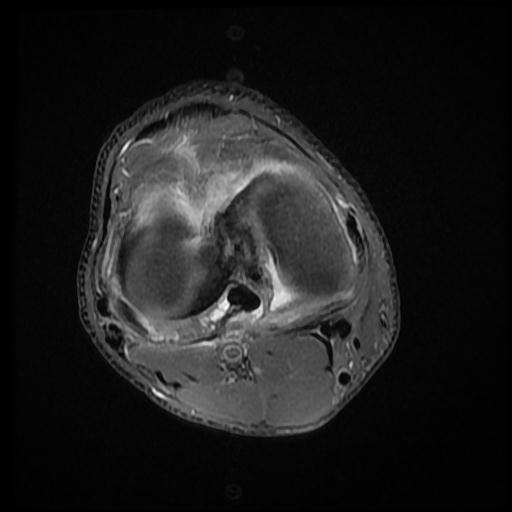 File:Bucket handle tear - medial meniscus (Radiopaedia 69245-79026 Axial PD fat sat 12).jpg