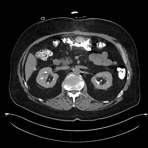 Buried bumper syndrome - gastrostomy tube (Radiopaedia 63843-72577 Axial Inject 38).jpg