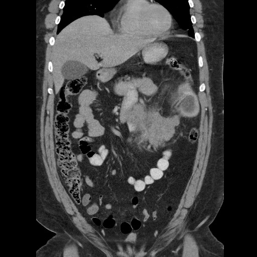 File:Burned-out testicular seminoma - retroperitoneal nodal metastases (Radiopaedia 62872-71245 B 25).jpg