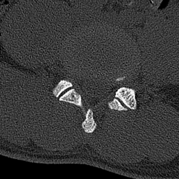 Burst fracture (Radiopaedia 53373-59357 Axial bone window 53).jpg