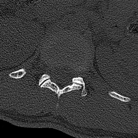 Burst fracture (Radiopaedia 53373-59357 Axial bone window 6).jpg