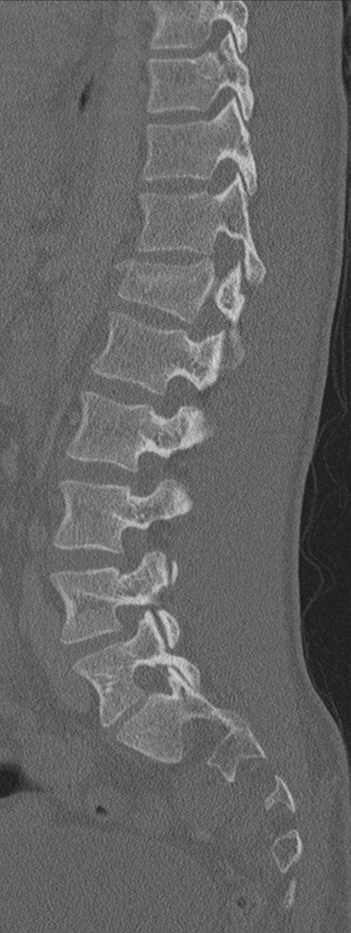 Burst fracture - T12 with conus compression (Radiopaedia 56825-63647 Sagittal bone window 32).png