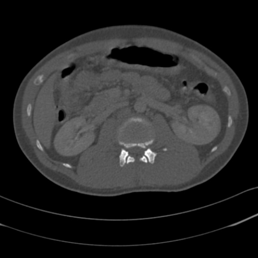 Burst fracture with cauda equina syndrome (Radiopaedia 25701-25867 Axial bone window 27).jpg