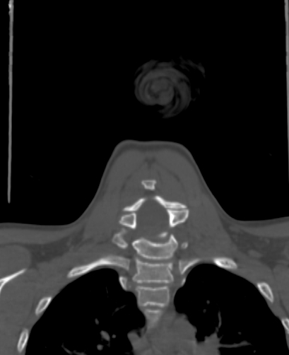 File:Butterfly vertebra (Radiopaedia 77903-90209 Coronal bone window 50).jpg