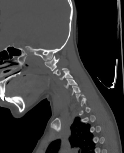 File:Butterfly vertebra (Radiopaedia 77903-90209 Sagittal bone window 5).jpg