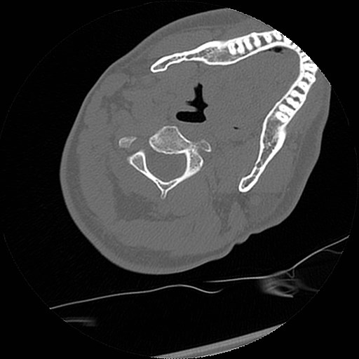 C1-C2 "subluxation" - normal cervical anatomy at maximum head rotation (Radiopaedia 42483-45607 Axial non-contrast 35).jpg