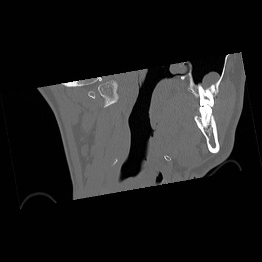 C1-C2 "subluxation" - normal cervical anatomy at maximum head rotation (Radiopaedia 42483-45607 Coronal non-contrast 4).jpg