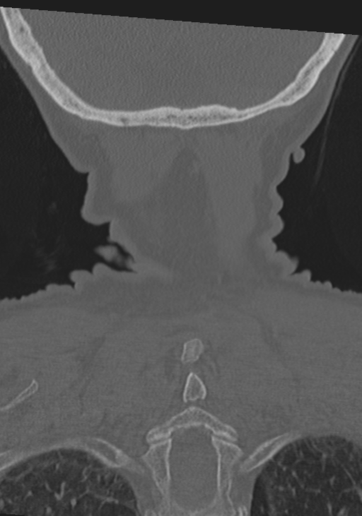 C2 fracture with vertebral artery dissection (Radiopaedia 37378-39199 Coronal bone window 53).png