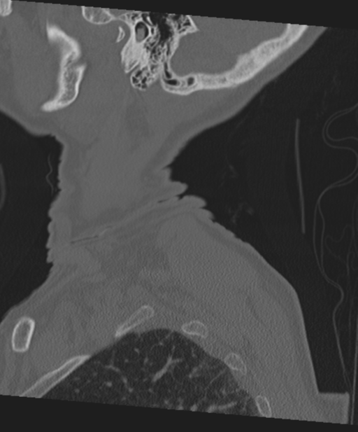 C2 fracture with vertebral artery dissection (Radiopaedia 37378-39199 Sagittal bone window 73).png