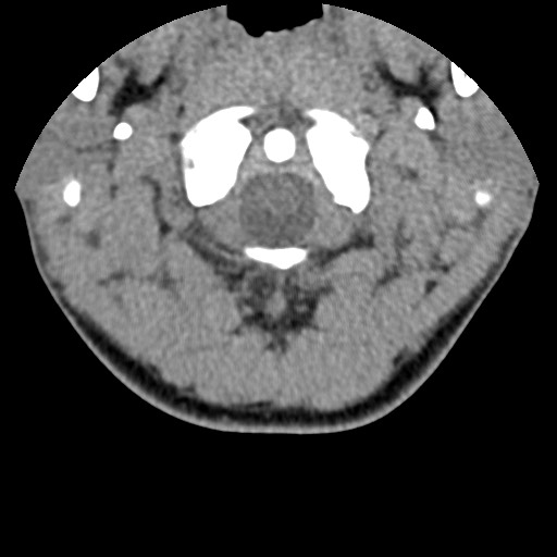 File:C5 facet fracture (Radiopaedia 58374-65499 Axial non-contrast 11).jpg