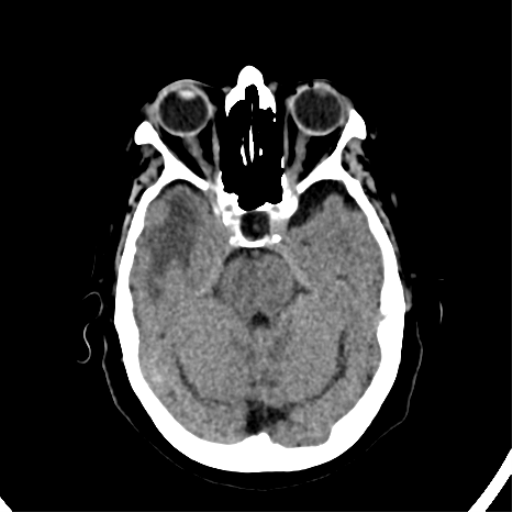 File:CNS Lymphoma (Radiopaedia 44198-47794 Axial non-contrast 13).png