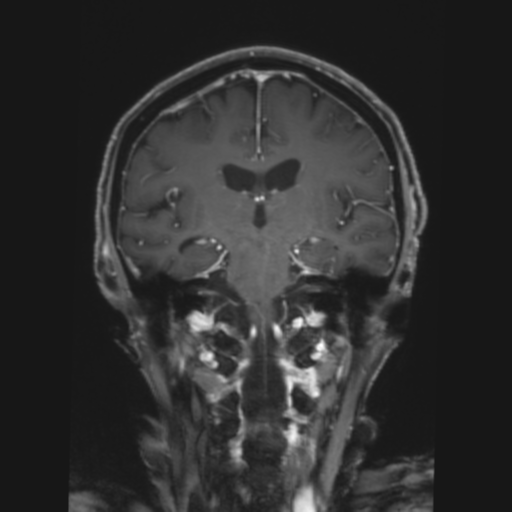 CNS lymphoma with steroid response (Radiopaedia 37980-39921 Coronal T1 C+ 25).png