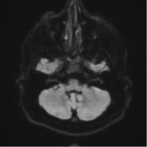 File:CNS vasculitis (Radiopaedia 55715-62263 Axial DWI 35).png