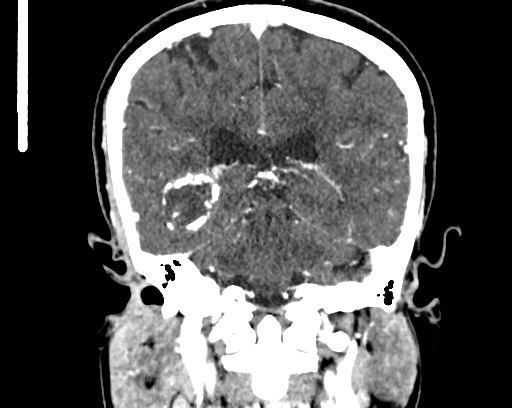 Calcified cerebral hydatid cyst (Radiopaedia 65603-74717 C 46).jpg
