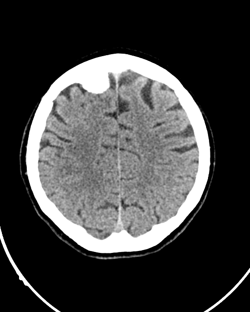 Calcified meningioma (Radiopaedia 74361-85243 Axial non-contrast 15).jpg