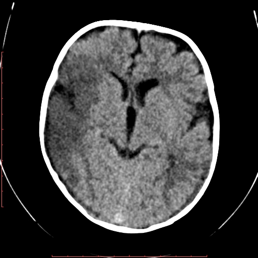 File:Calcified middle cerebral artery embolism (Radiopaedia 78949-91860 Axial non-contrast 12).jpg