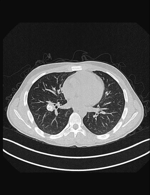 Calcifying pulmonary metastases (Radiopaedia 33359-34396 Axial lung window 36).jpg