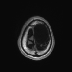 Callosal dysgenesis with interhemispheric cyst (Radiopaedia 53355-59335 Axial T1 144).jpg
