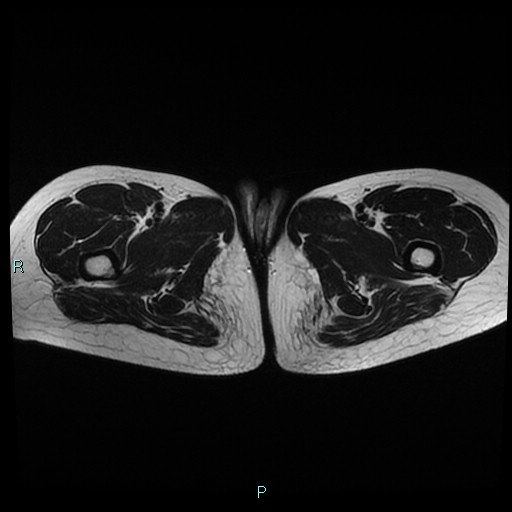 File:Canal of Nuck cyst (Radiopaedia 55074-61448 Axial T2 27).jpg