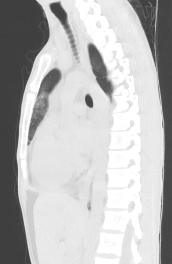 Cannabis-induced diffuse alveolar hemorrhage (Radiopaedia 89834-106946 Sagittal lung window 73).jpg