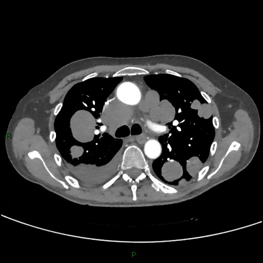 Cannonball metastases (Radiopaedia 82110-96150 Axial C+ CTPA 130).jpg