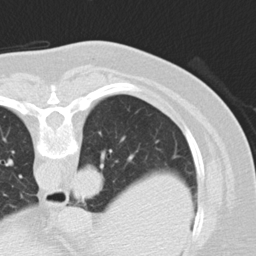 Carcinoid tumor - lung (Radiopaedia 44814-48644 Axial lung window 9).png