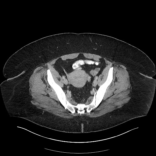 Carcinoid tumor - terminal ileum (Radiopaedia 60931-68739 A 109).jpg