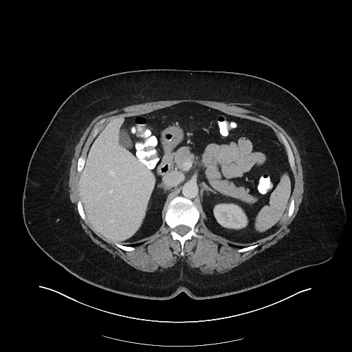 File:Carcinoid tumor - terminal ileum (Radiopaedia 60931-68739 Axial 55).jpg