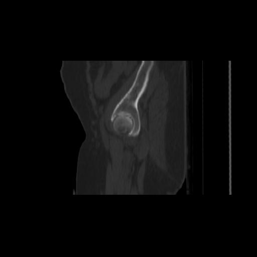 File:Carcinoma cervix- brachytherapy applicator (Radiopaedia 33135-34173 Sagittal bone window 13).jpg
