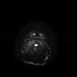 Carcinoma ex-pleomorphic adenoma of parotid (Radiopaedia 28383-28627 Ax DWI B-500 GE 39).jpg