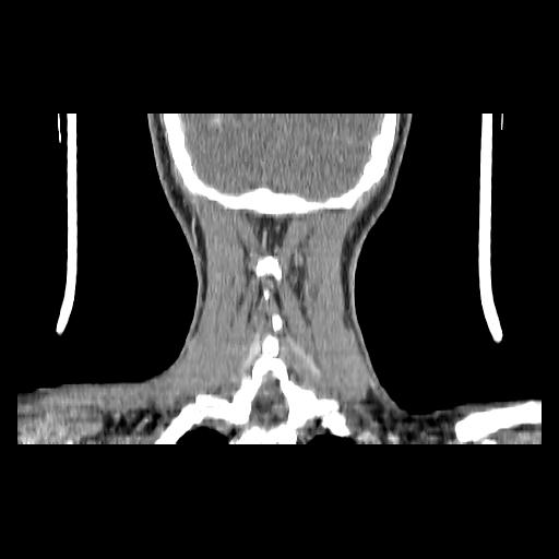 Carcinoma of the maxillary antrum (Radiopaedia 53805-59888 Coronal C+ delayed 144).jpg