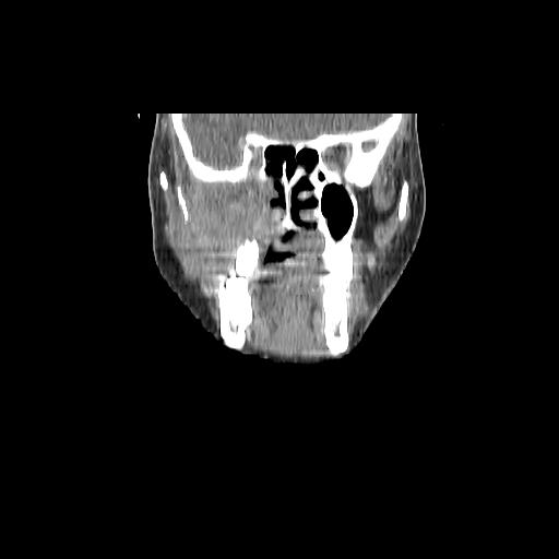 File:Carcinoma of the maxillary antrum (Radiopaedia 53805-59888 Coronal C+ delayed 49).jpg